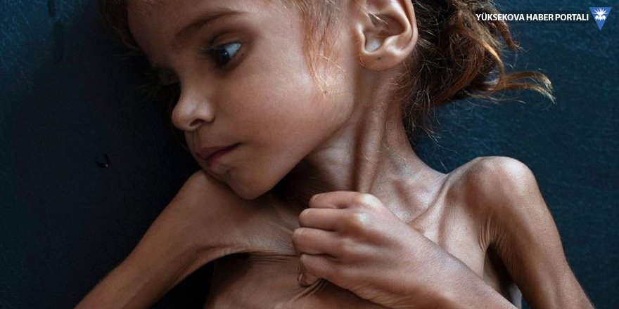 Yemen'deki savaşın 7 yaşındaki sembolü Emel hayatını kaybetti