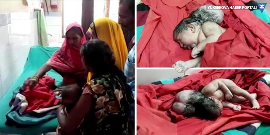 Hindistan'da üç başlı bebek doğdu