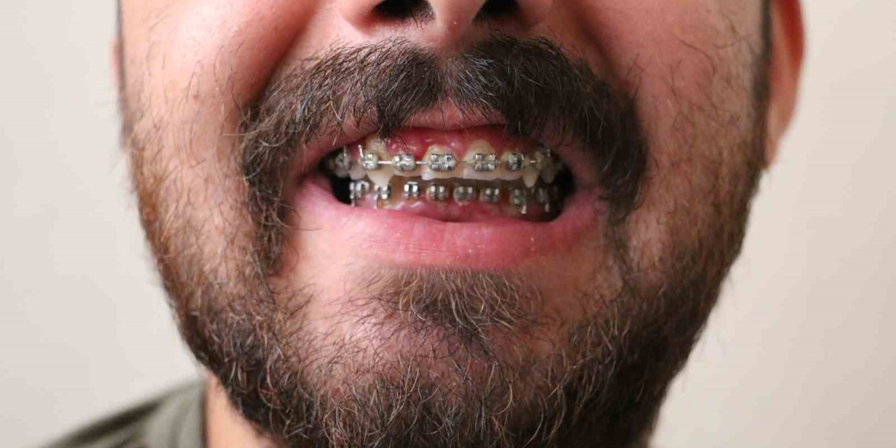 Diyarbakır'da 5 yaşındayken geçirdiği havale sonucu çene yapısı bozuldu, 21 yıldır sağlığına kavuşmanın hayaliyle yaşıyor