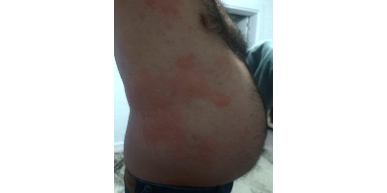 Karakoçan'da böcek ısırığı hastanelik etti