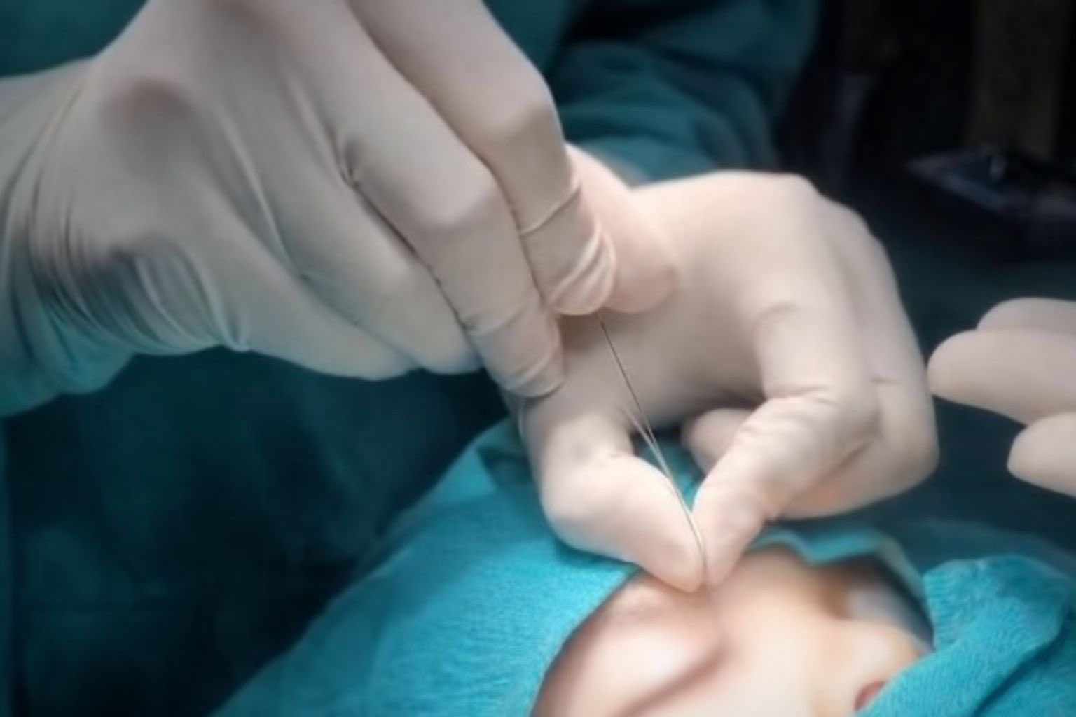 Gözyaşı kanal tıkanıklıkları artık Çukurca’da tedavi ediliyor