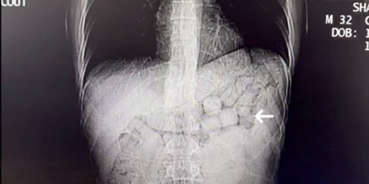 Midelerinde taşıdıkları 807 gram uyuşturucu ile yakalanan 2 kişi tutuklandı