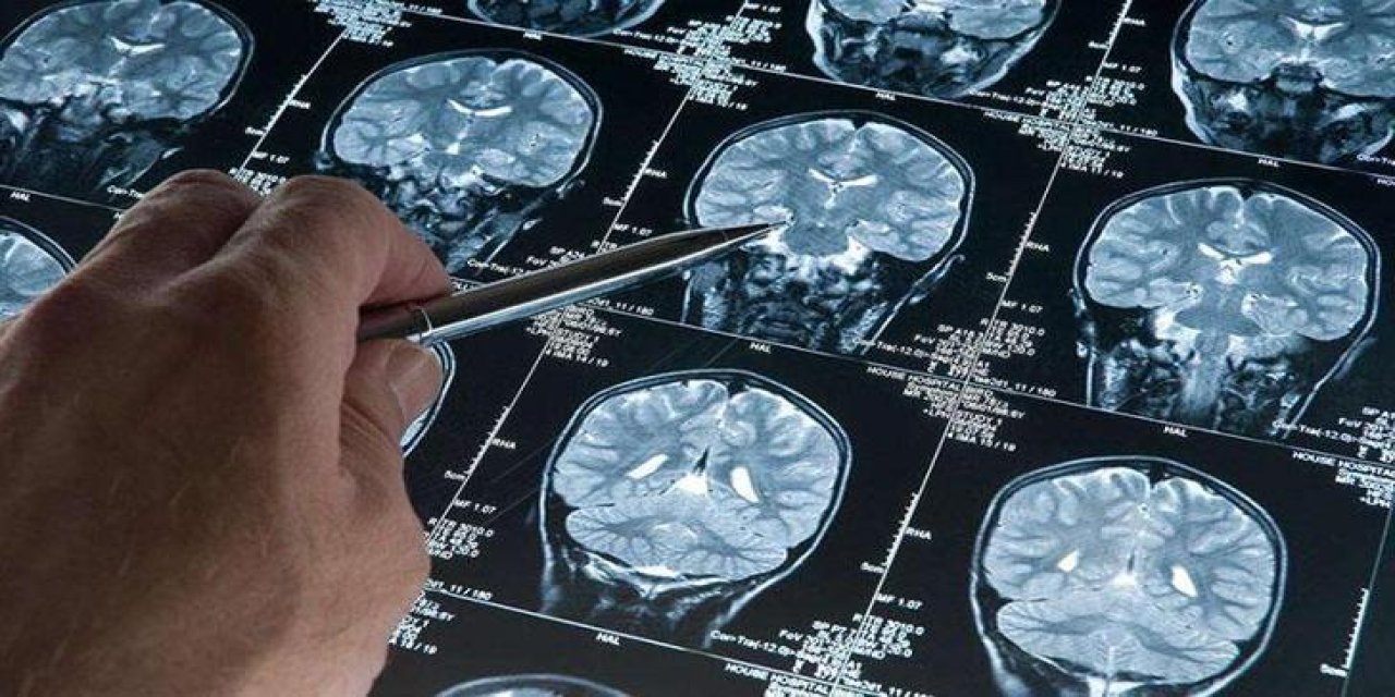 Araştırma: Alzheimer düşünüldüğünden daha erken başlayabilir