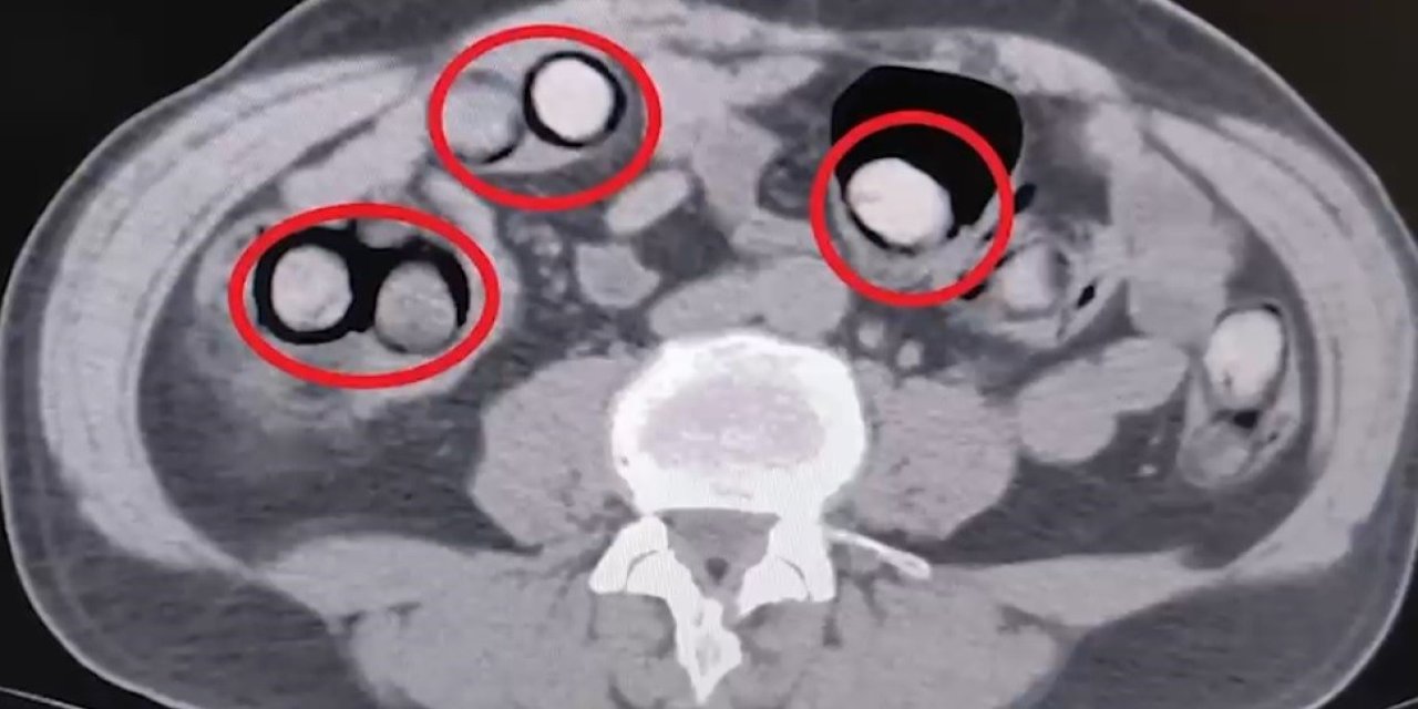 Mide ve bağırsaklarından 758 gram uyuşturucu çıktı
