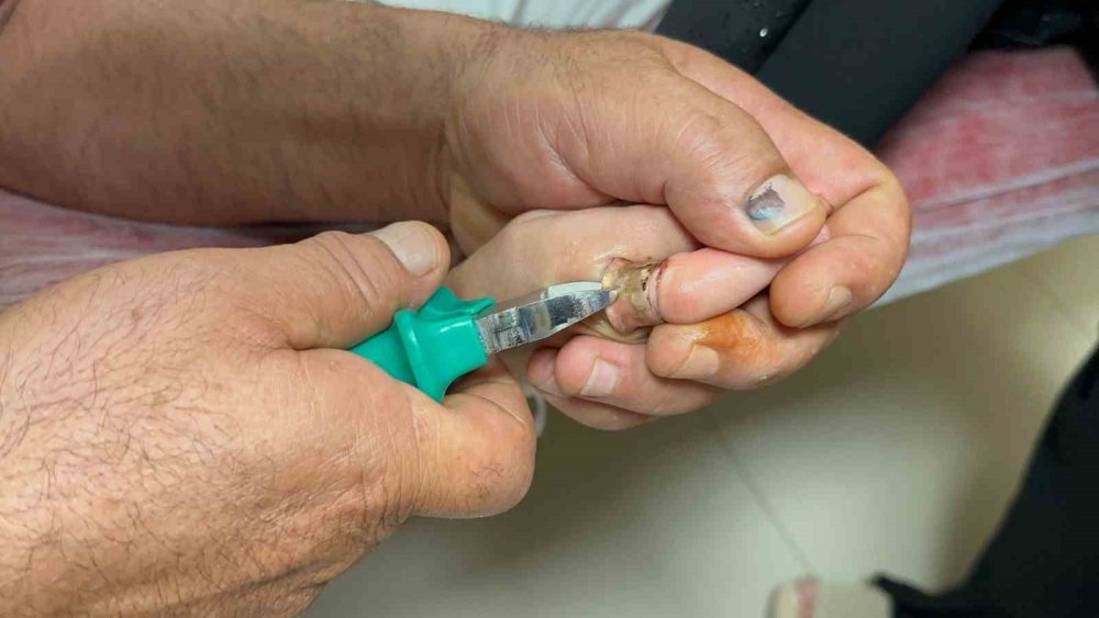 Çocuğun parmağına sıkışan metal cisim, kesilerek çıkarıldı