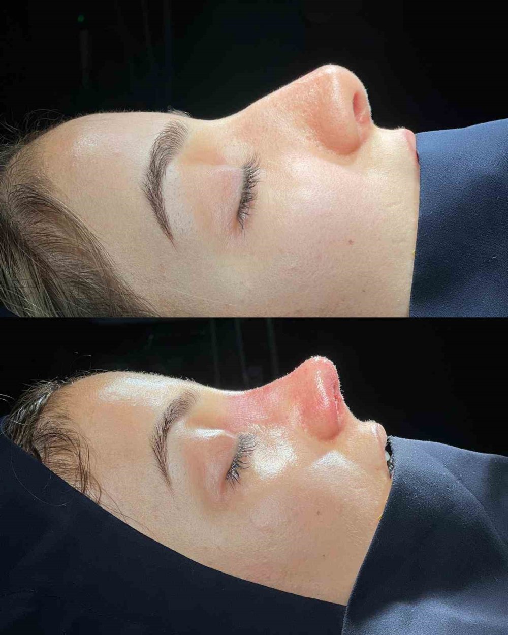 Cizre’de ilk defa revizyon rinoplasti ameliyatı yapıldı